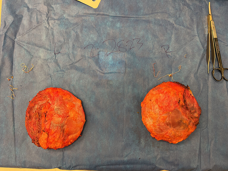 Capsules — Patient result