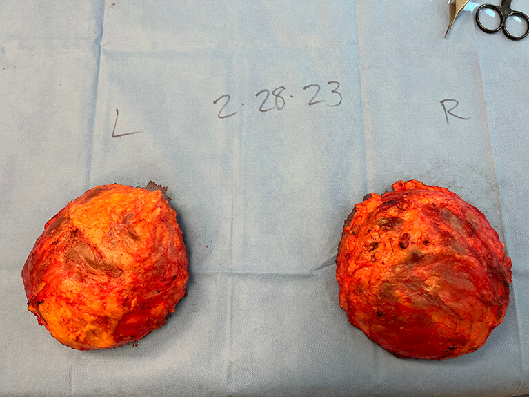 Capsules — Patient result