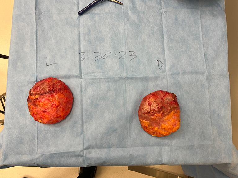 Capsules — Patient result