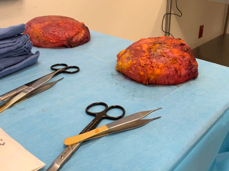 Capsules — Patient result