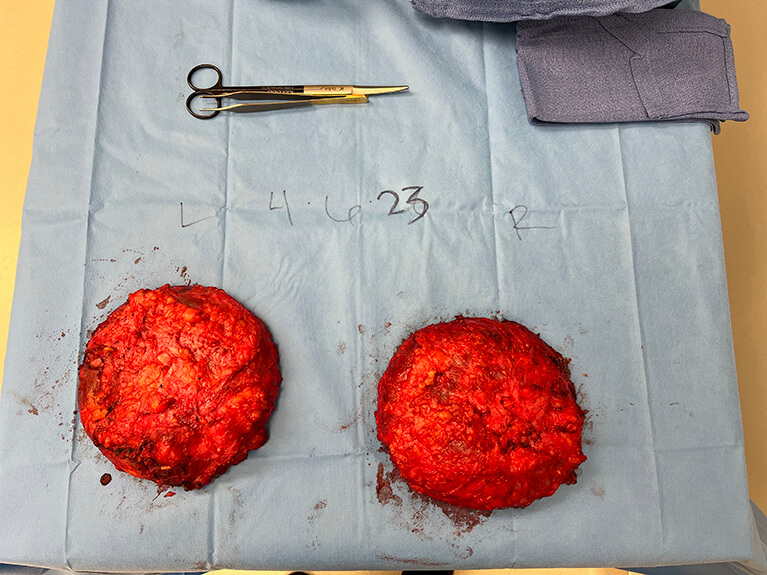 Capsules — Patient result