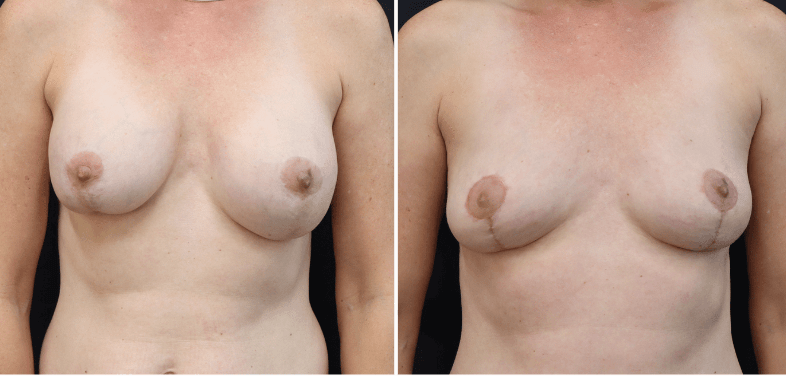 Breast Implant Removal + Lift + Fat Transfer — Patient result
