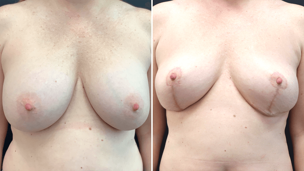 Breast Implant Removal + Lift — Patient result
