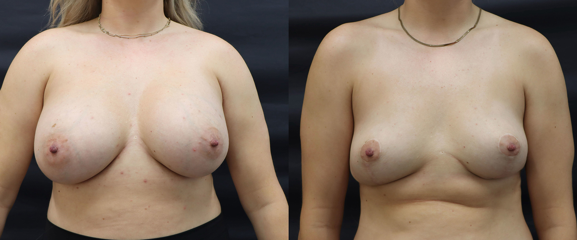 Breast Implant Removal + Lift — Patient result
