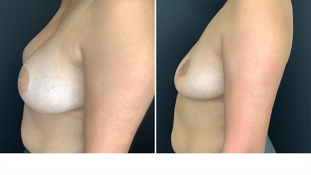 Breast Implant Removal + Lift — Patient result