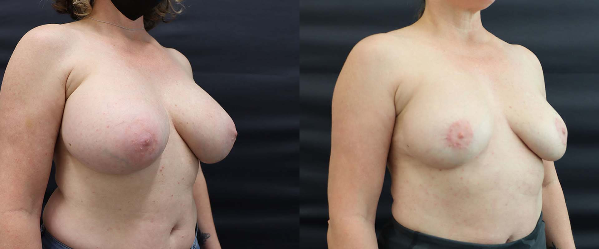 Breast Implant Removal + Lift — Patient result