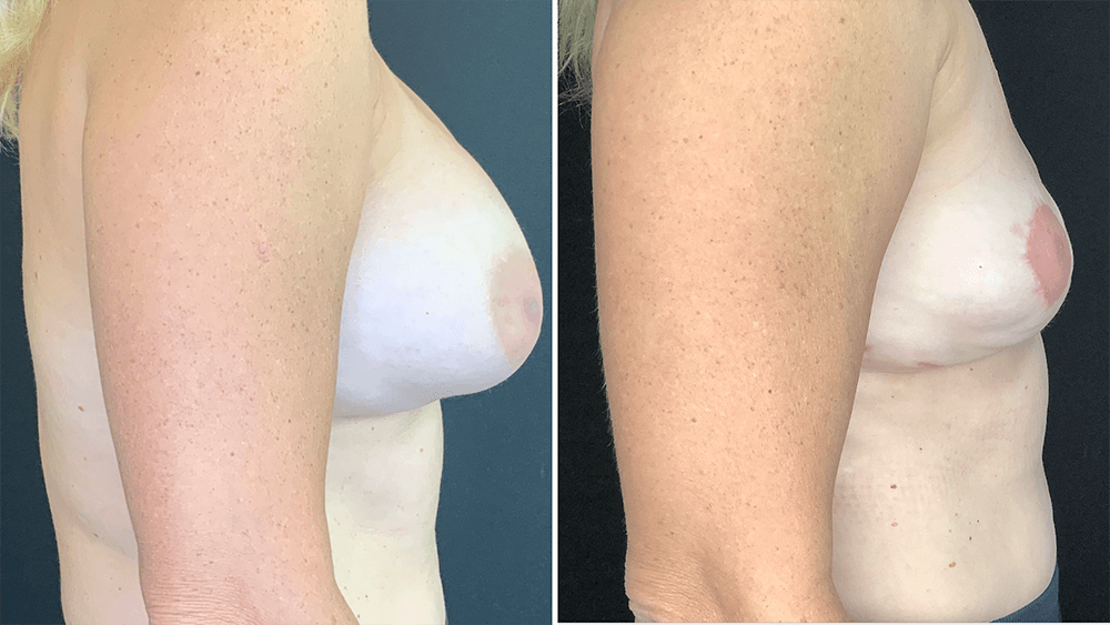 Breast Implant Removal — Patient result