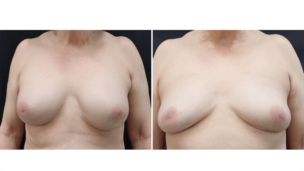 Breast Implant Removal — Patient result