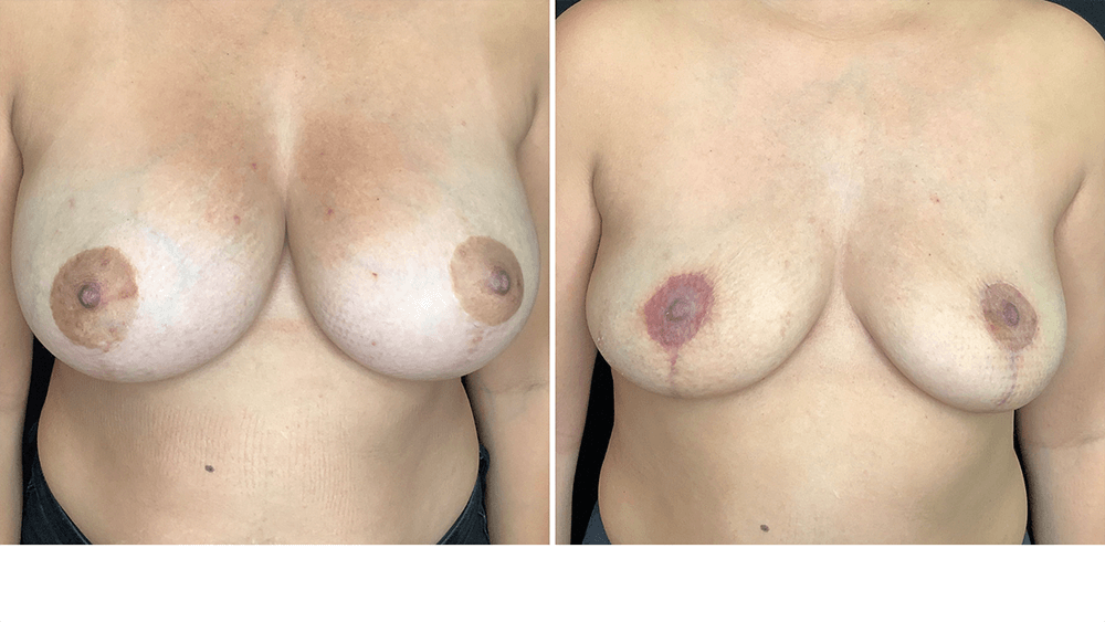 Breast Implant Removal — Patient result