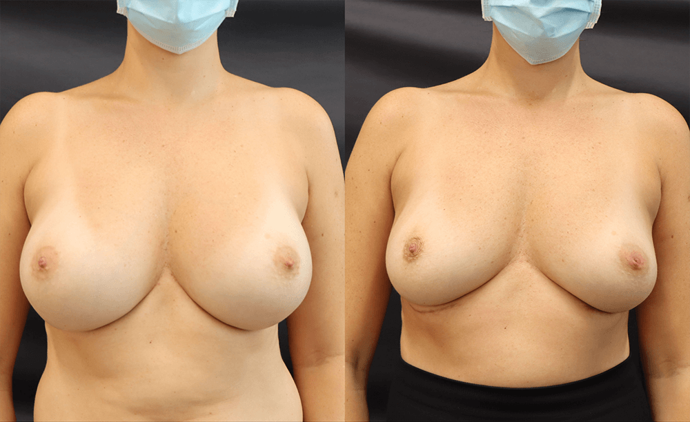Breast Implant Removal — Patient result