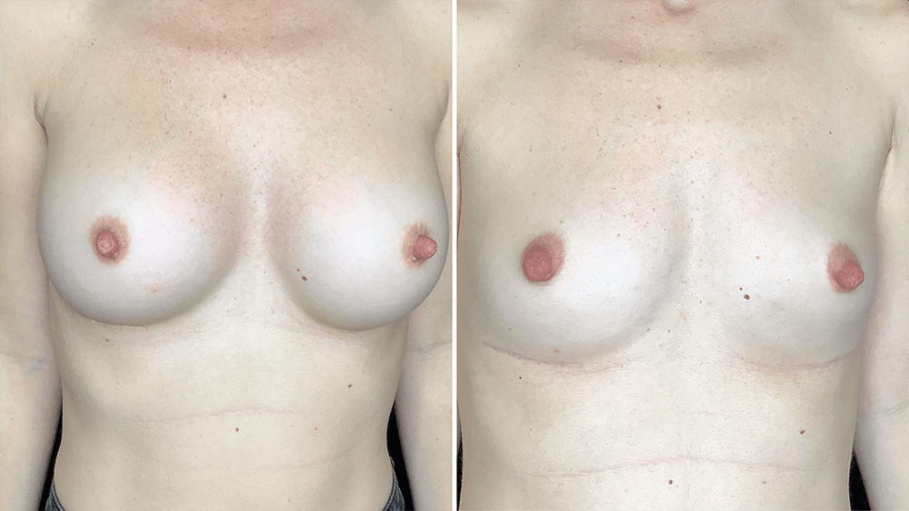 Breast Implant Removal — Patient result