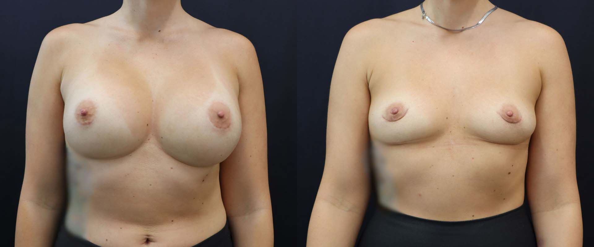 Breast Implant Removal — Patient result