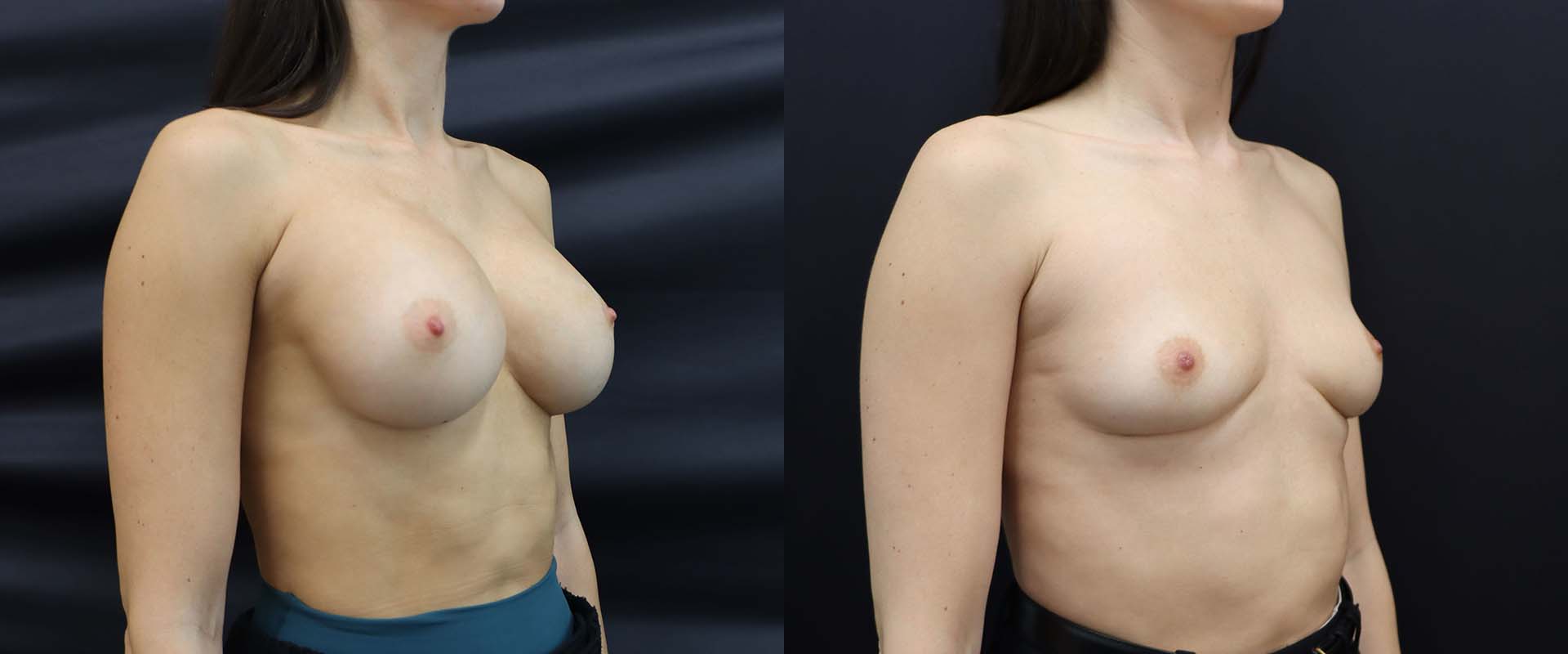 Breast Implant Removal — Patient result