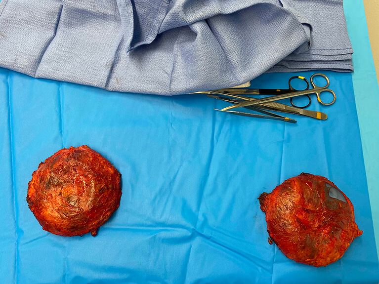 Capsules — Patient result