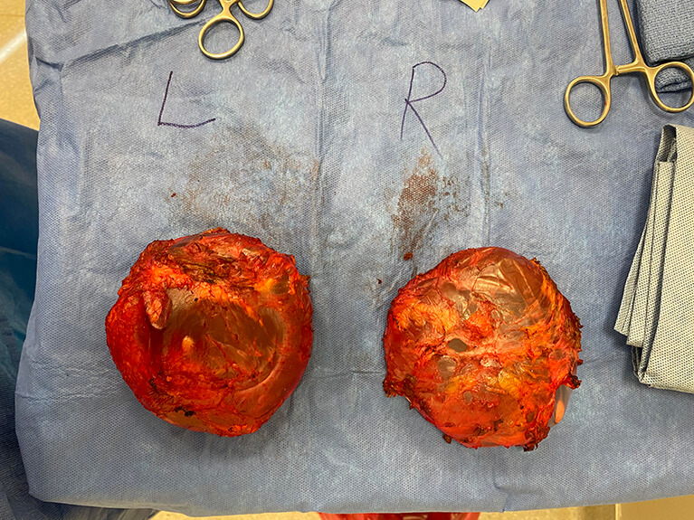 Capsules — Patient result