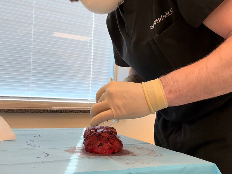 Capsules — Patient result