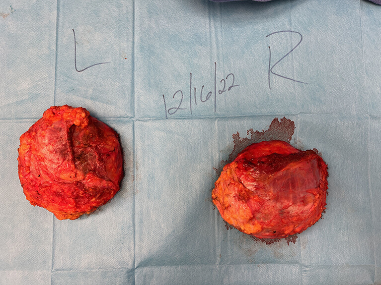 Capsules — Patient result