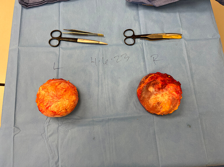 Capsules — Patient result