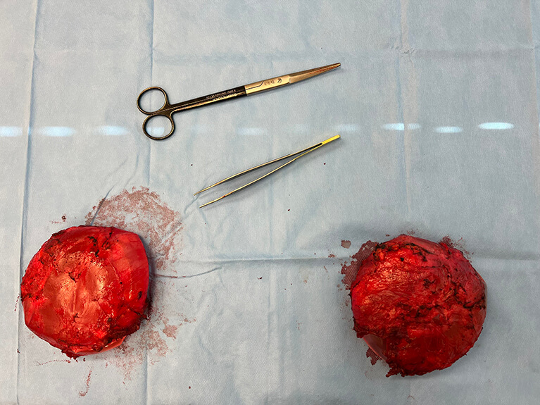 Capsules — Patient result