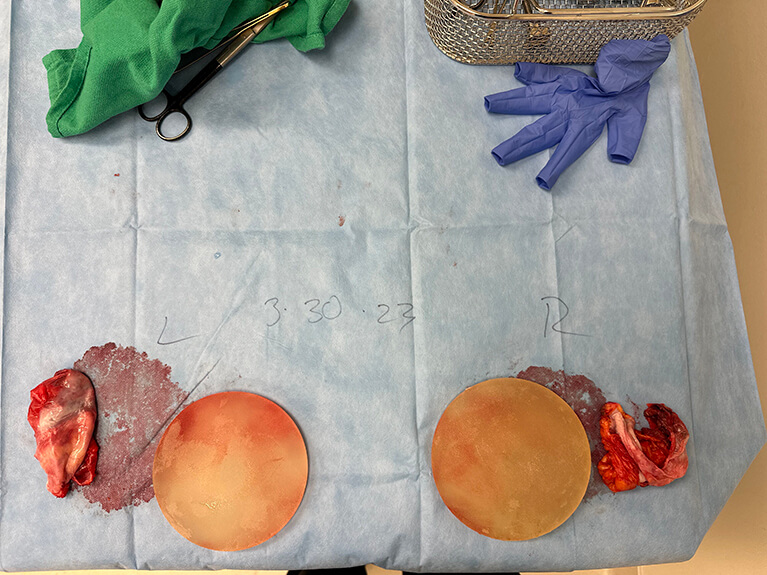 Capsules — Patient result