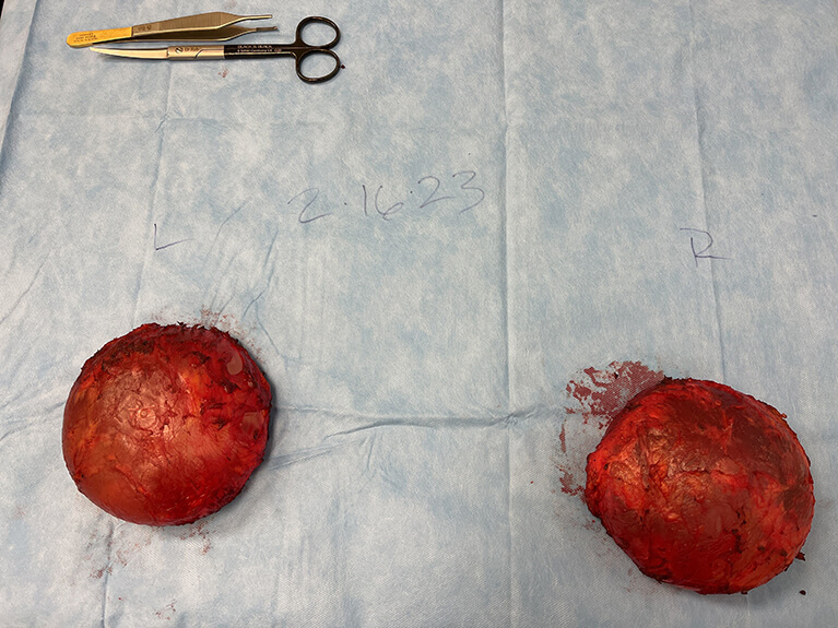 Capsules — Patient result