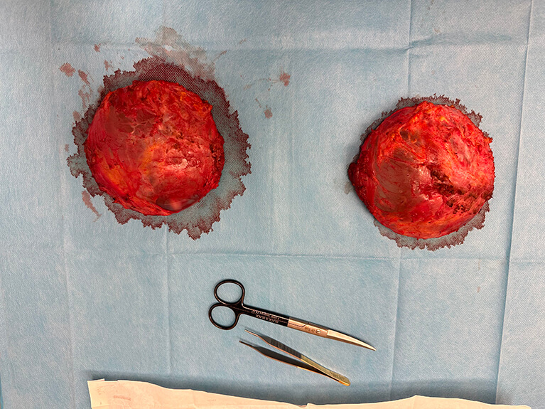 Capsules — Patient result