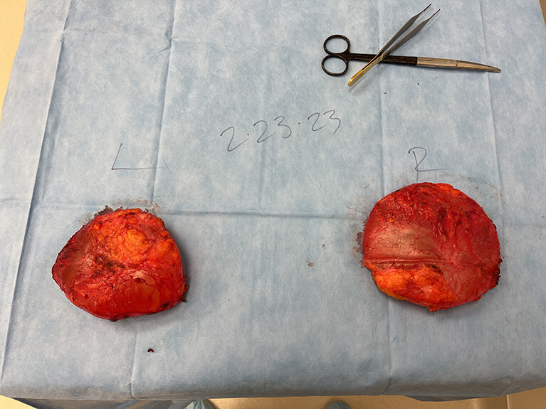 Capsules — Patient result