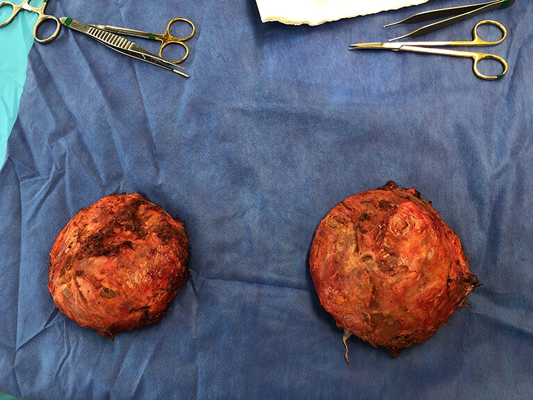 Capsules — Patient result