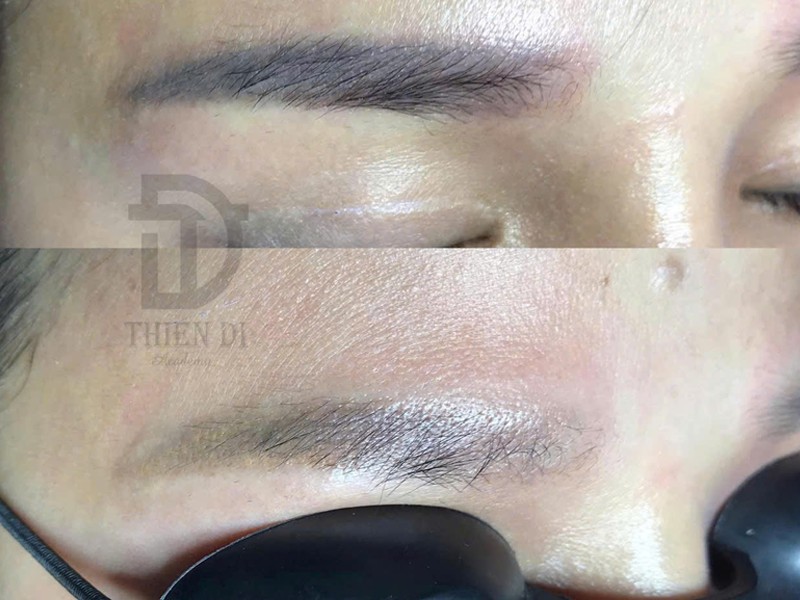 Xóa lông mày laser - Thien Di Brows