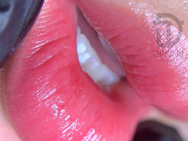 Trẻ hóa môi Plasma - Thien Di Brows