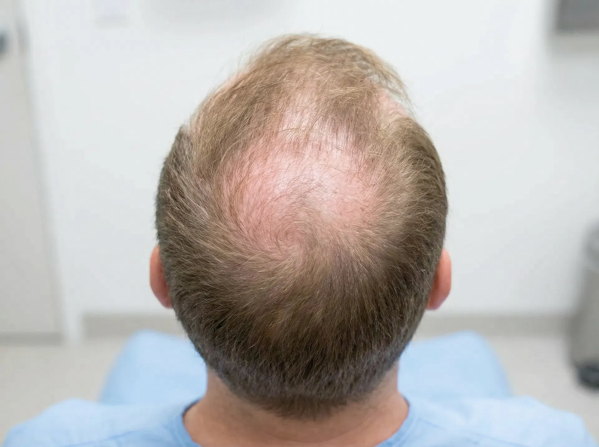 Back view of patient showing large bald spot on back crown area with full hair at the front before hair transplant