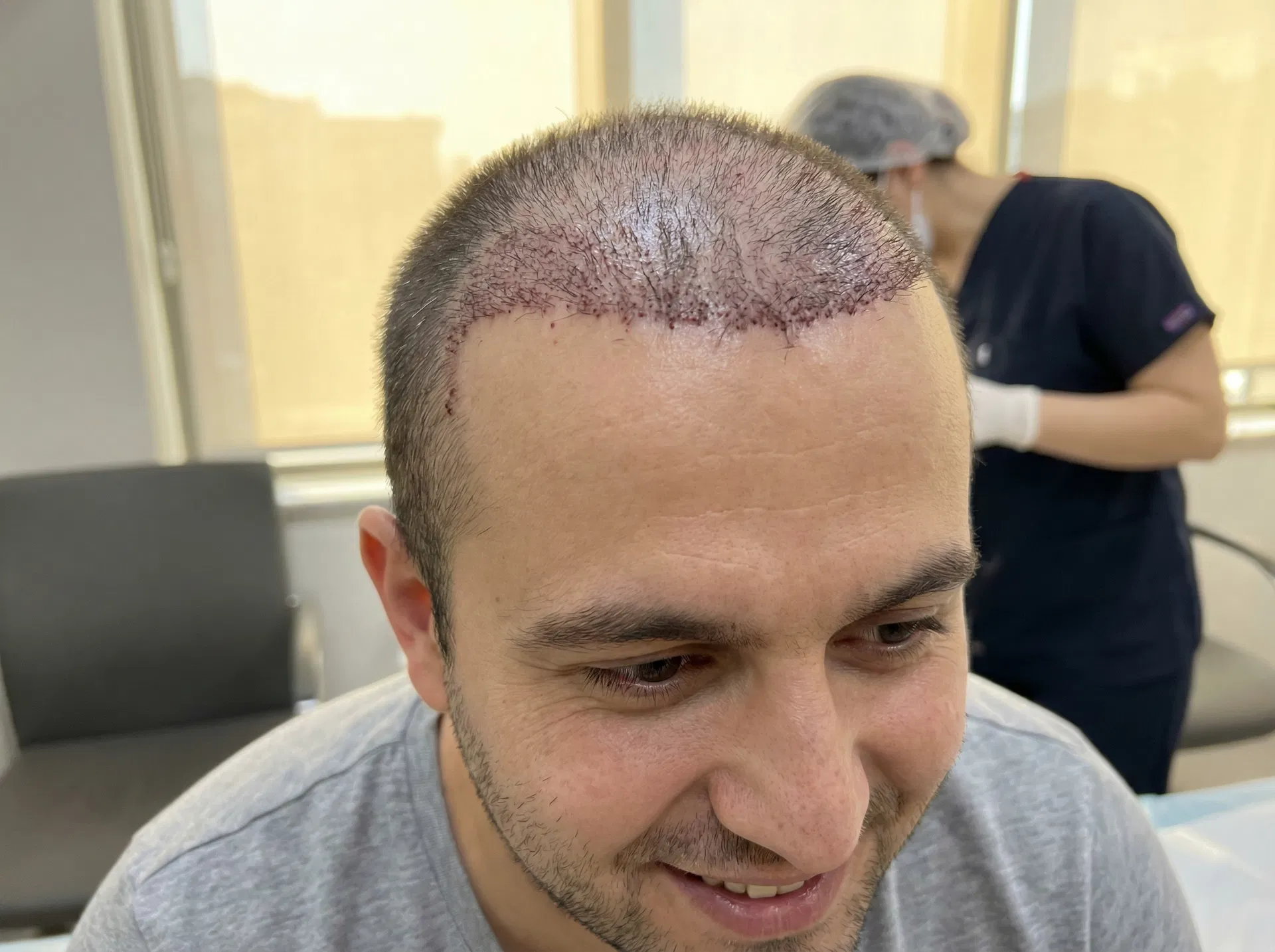 Close-up of early hair growth three months after hair transplant in Turkey showing fine new hairs emerging along the hairline