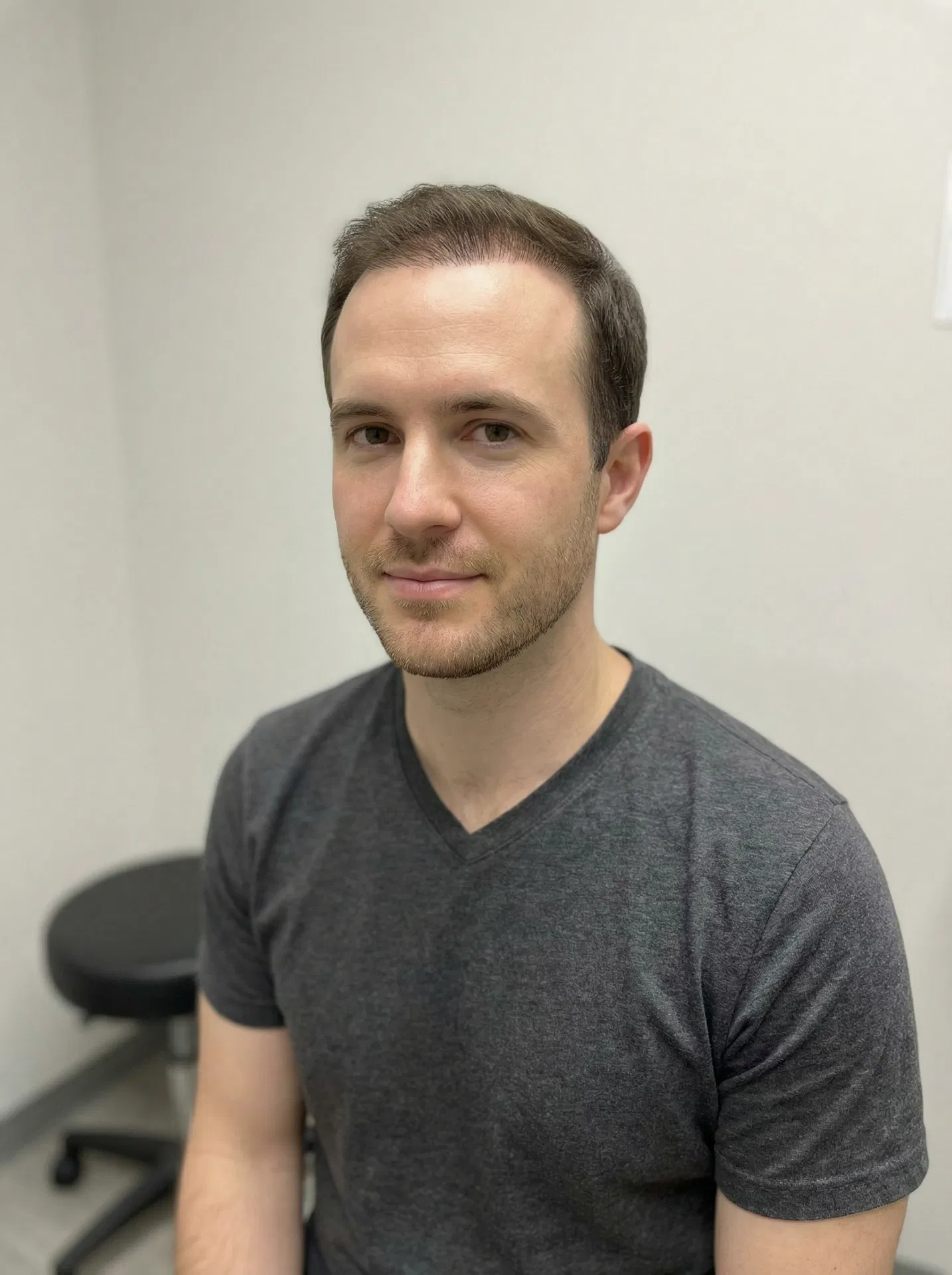 Same Canadian man 12 months after Sapphire FUE hair transplant in Turkey with full restored hairline and natural density