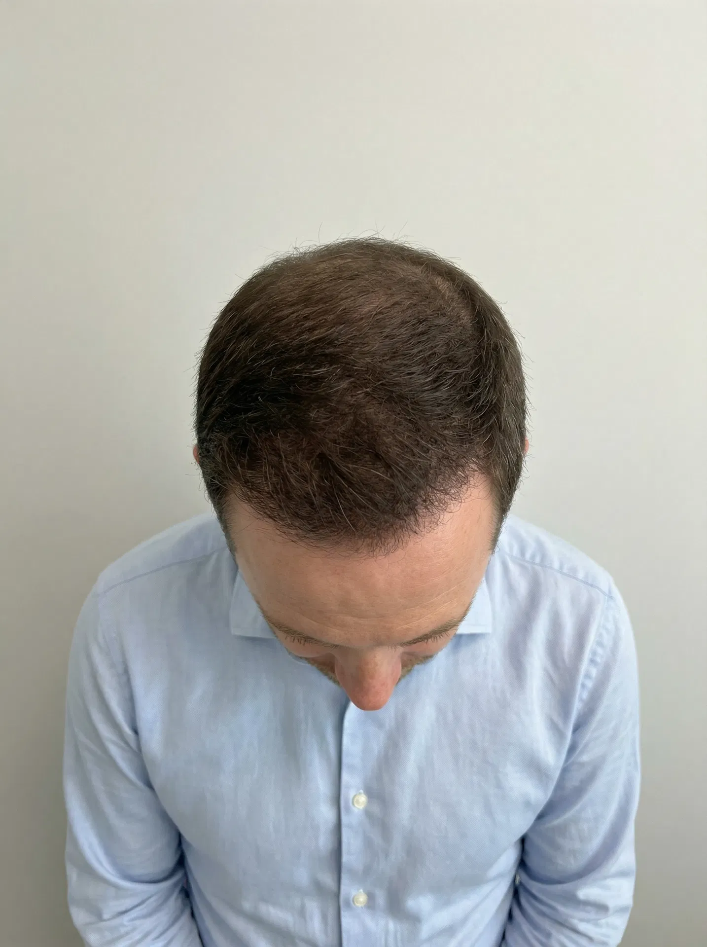 Top view of same patient scalp 12 months after hair transplant showing full crown hair restoration against plain wall