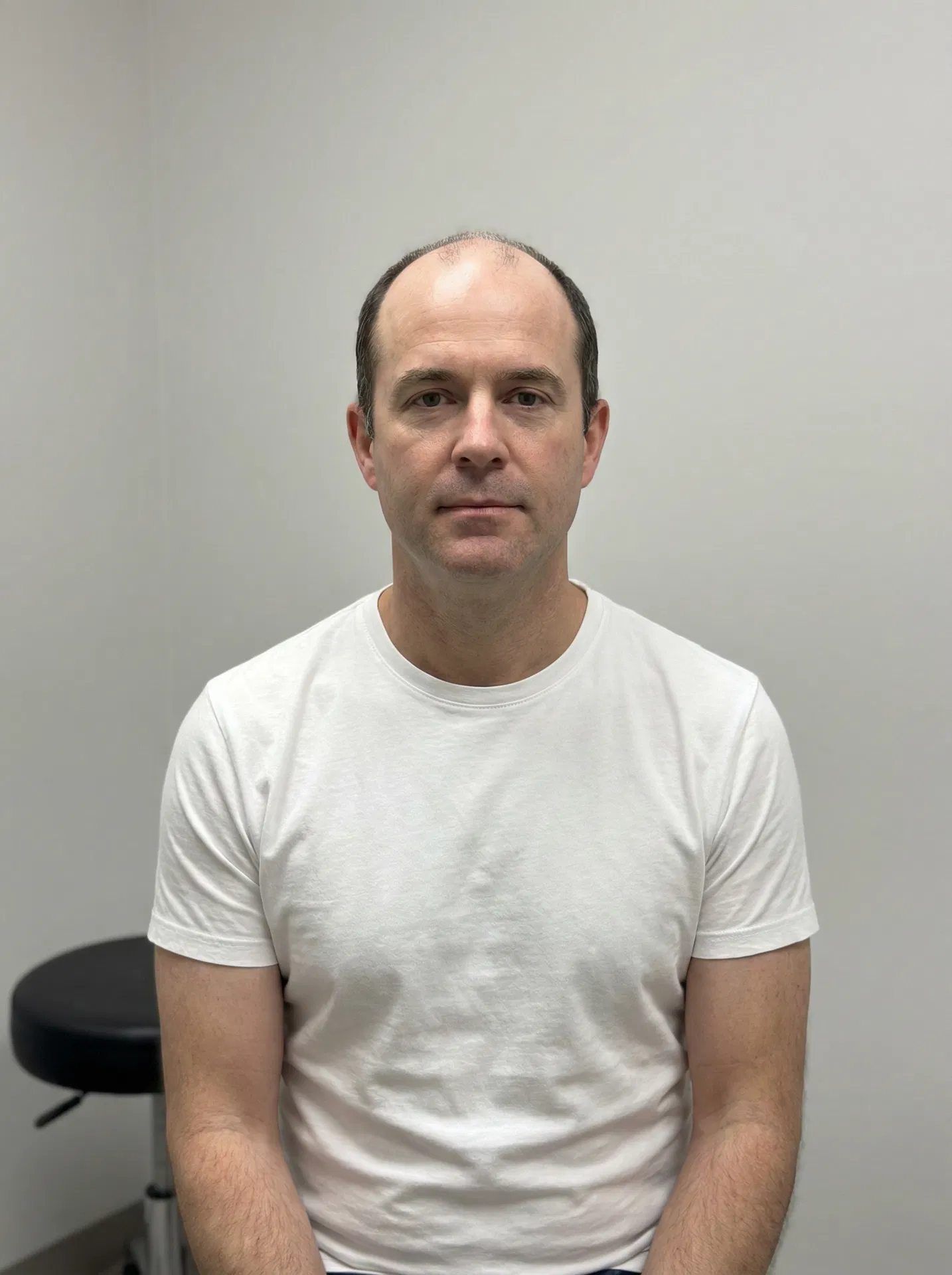 Patient before hair transplant showing advanced crown hair loss at Norwood stage 5 front view