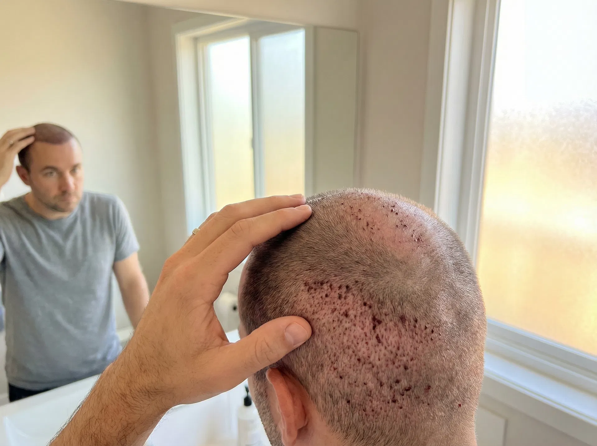 Hair transplant patient one week after surgery examining healing scalp with small scabs visible in transplant area