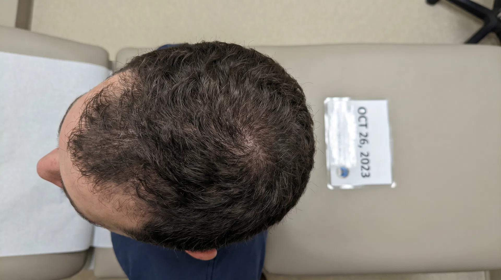 Fully restored crown area with dense natural hair coverage after transplant