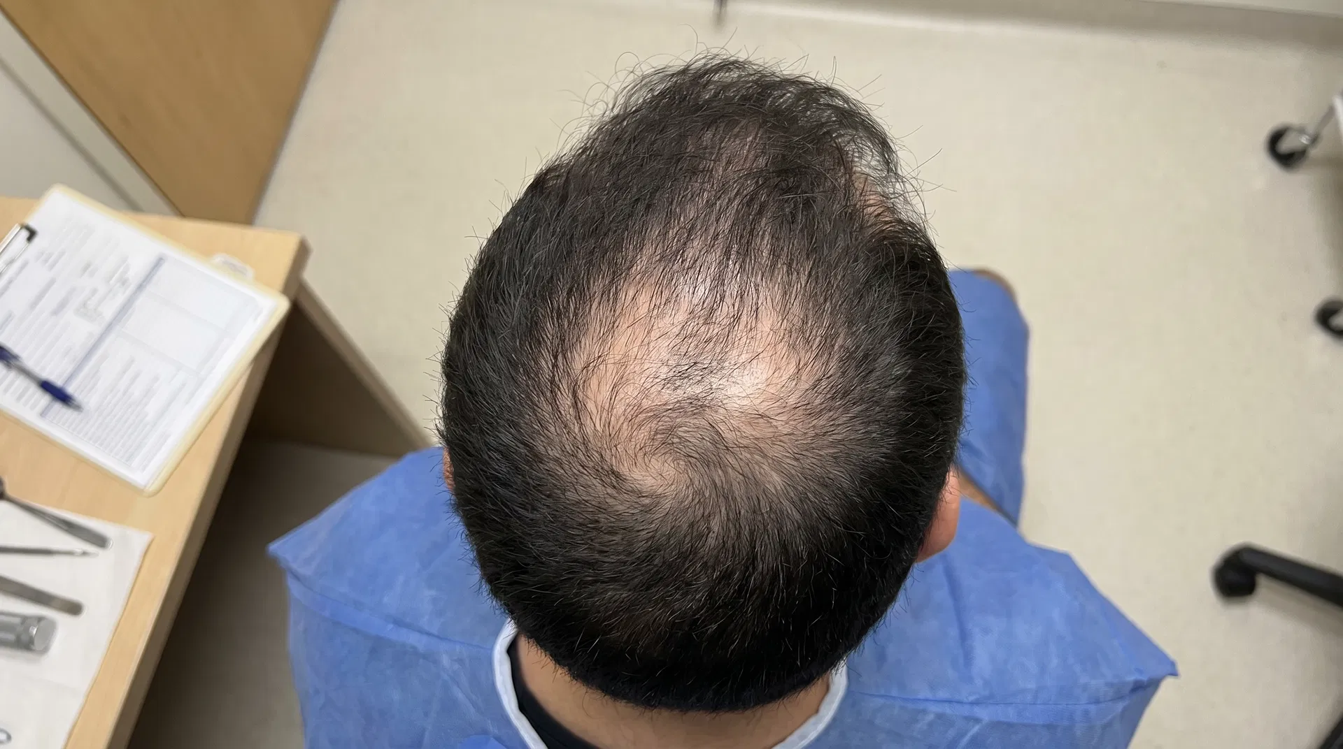 Top-down view of significant crown thinning with scalp visible