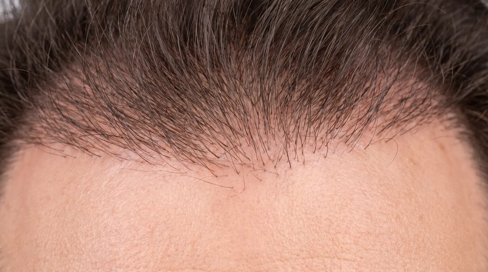 Close-up of perfectly natural-looking transplanted hairline