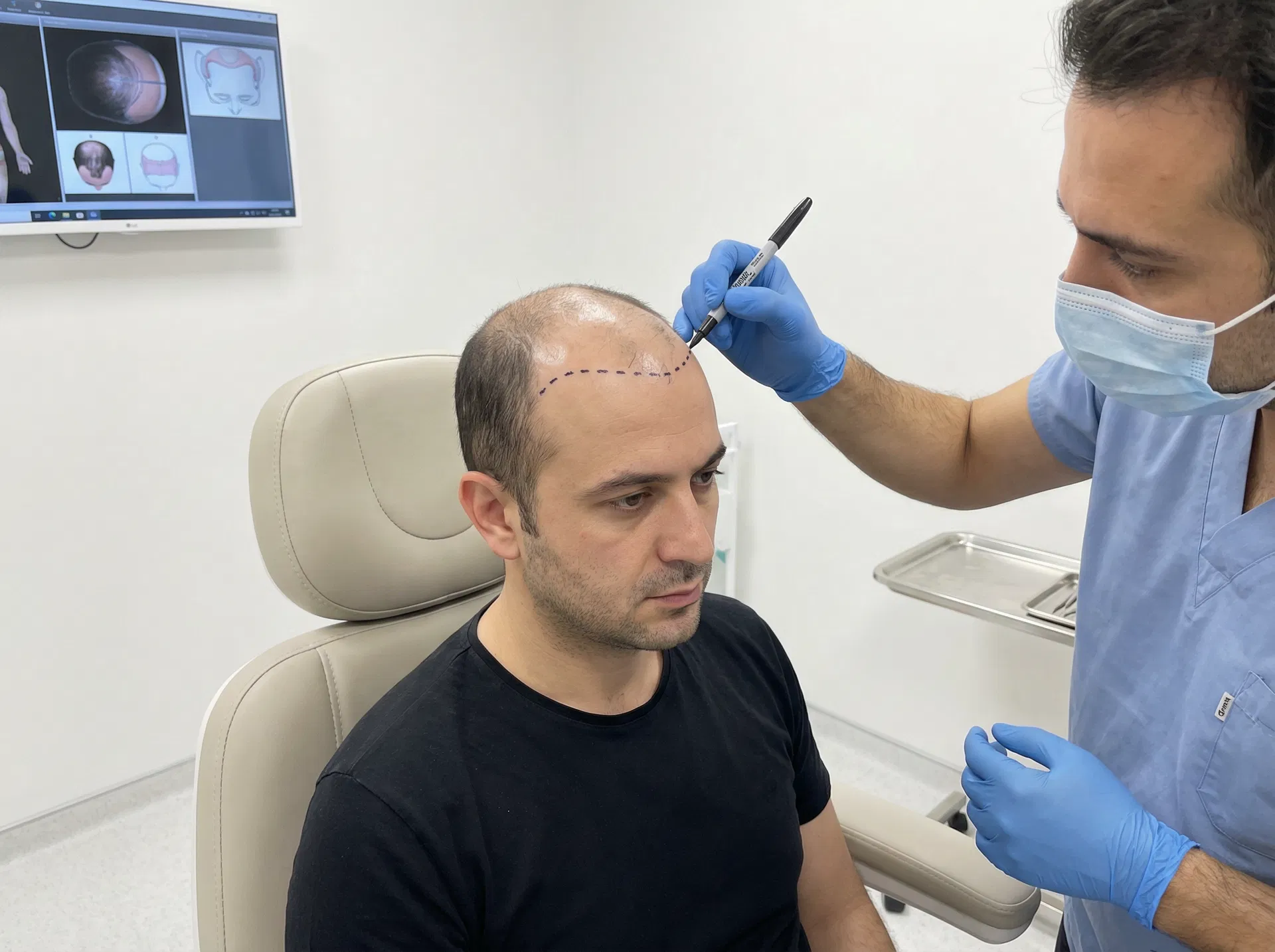 Hair transplant surgeon drawing a natural hairline on a patient before the procedure in Turkey