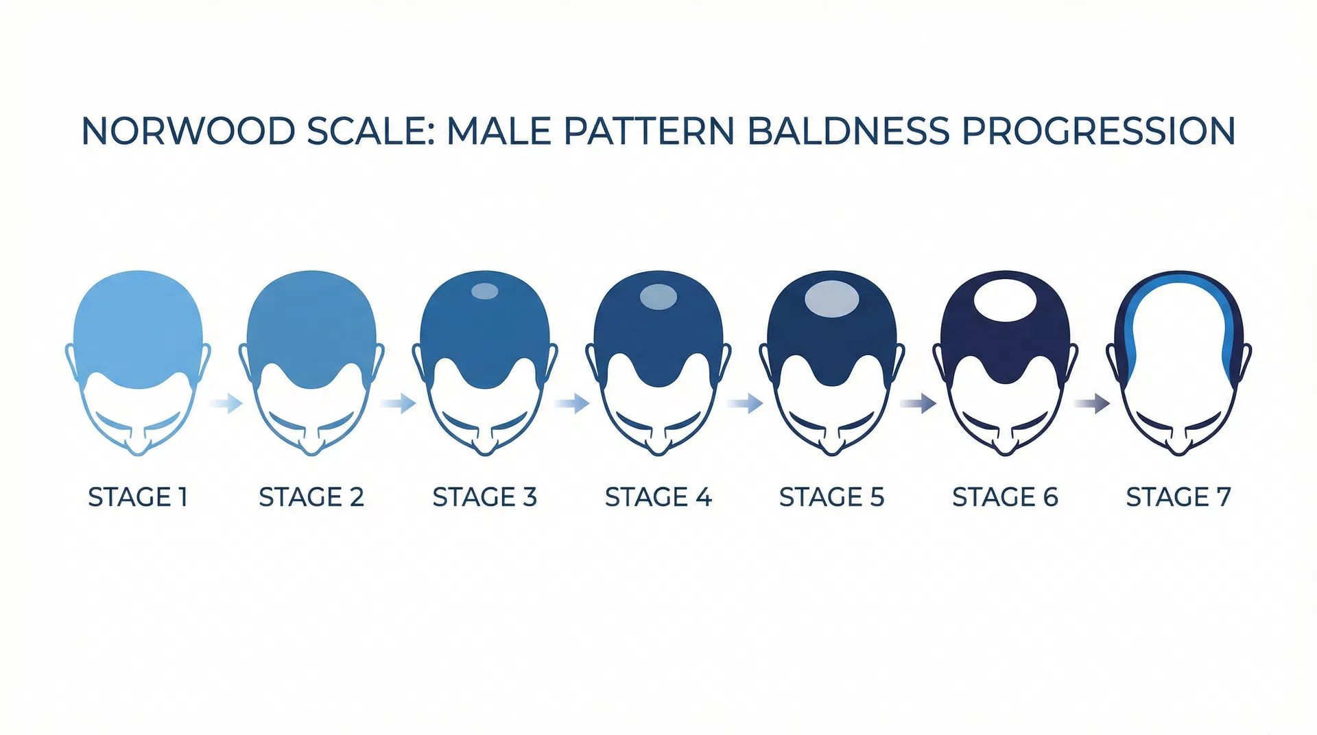 Norwood Scale showing 7 stages of male pattern baldness progression used by hair transplant surgeons in Turkey