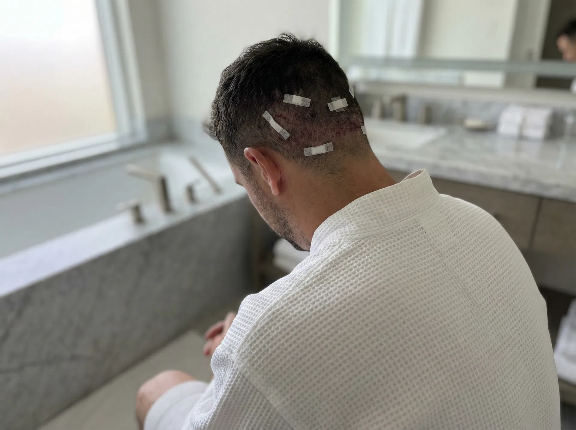 Patient recovering in hotel after hair transplant with bandages on donor area