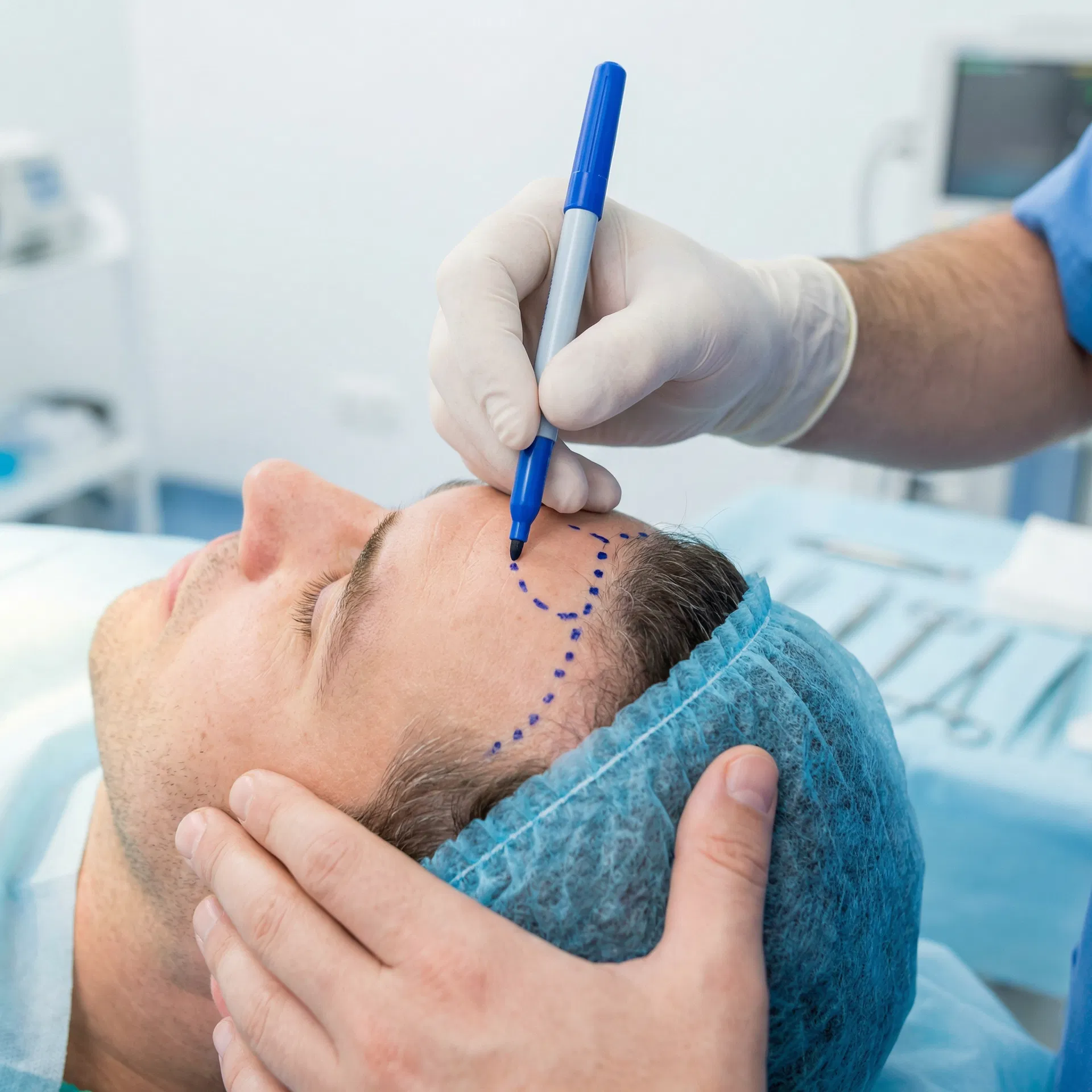 Surgeon carefully designing a natural hairline on a patient