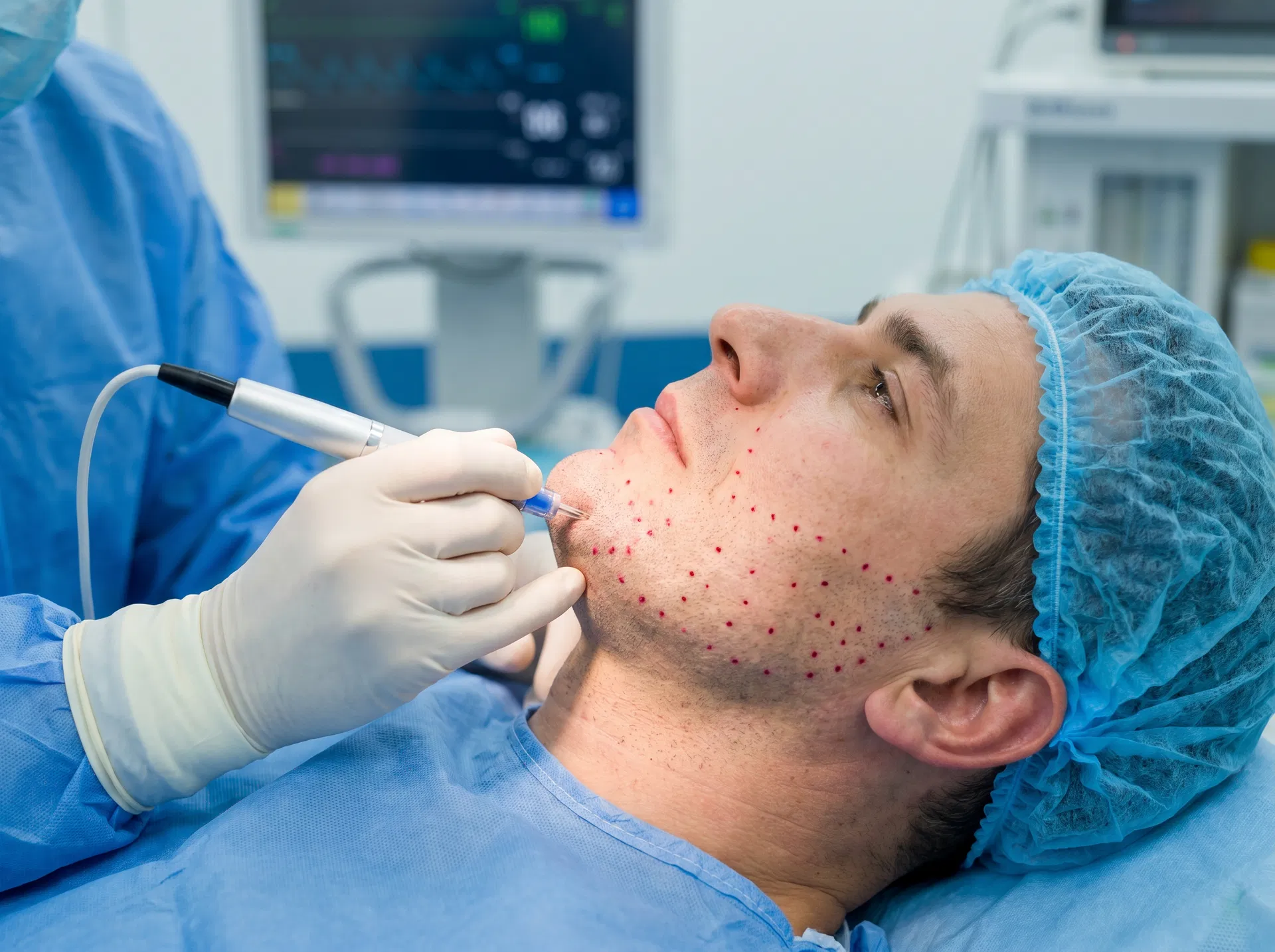 Beard Transplant hair transplant technique offered at Turkeyana Clinic Turkey