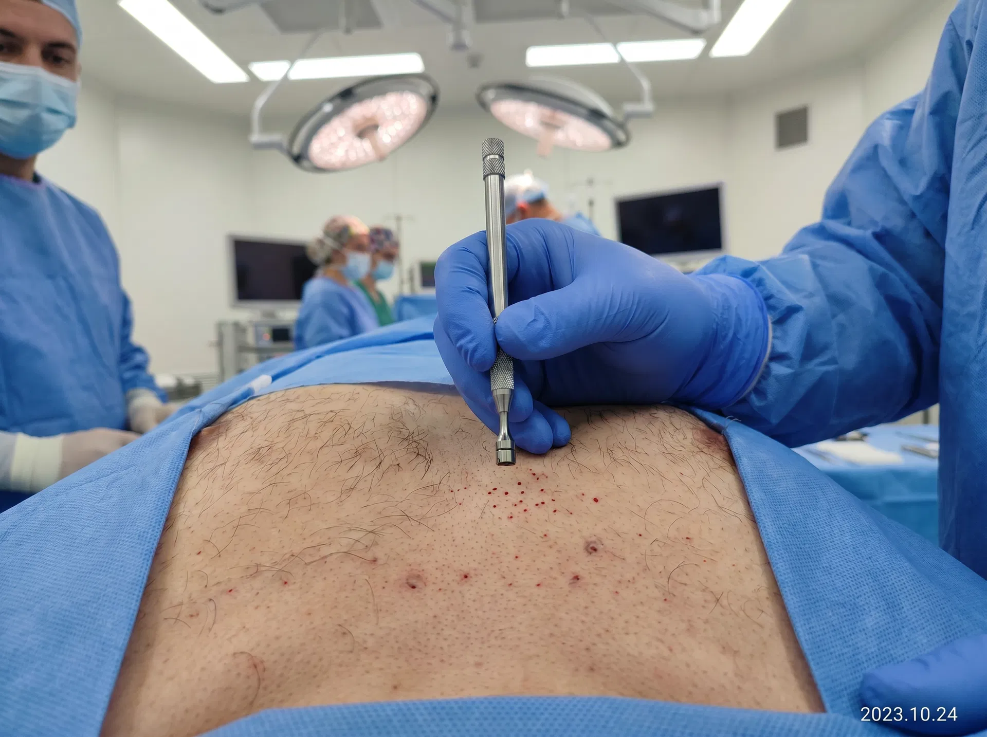 Body Hair Transplant (BHT) hair transplant technique offered at HLC Hairline Clinic Turkey