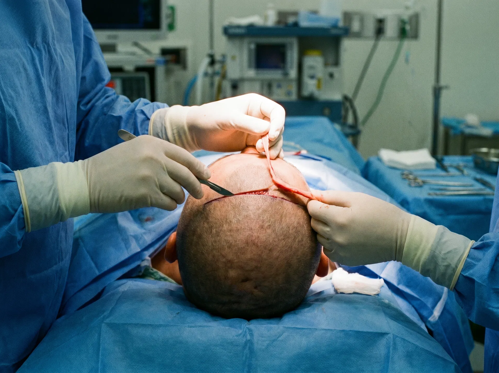 FUT (Follicular Unit Transplantation) hair transplant technique offered at Natural Hair Turkey Turkey