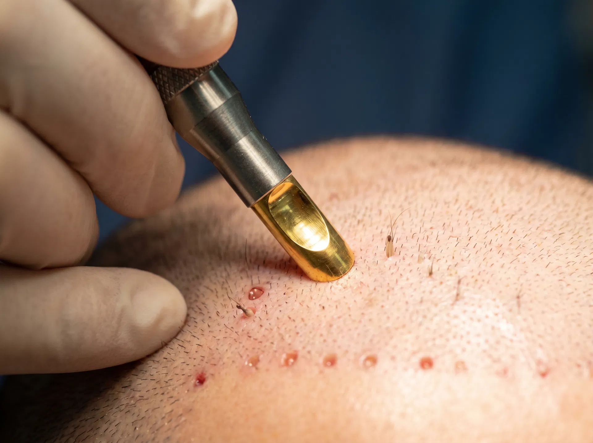 Gold-Tip FUE hair transplant technique offered at Istanbul Hair Center Turkey