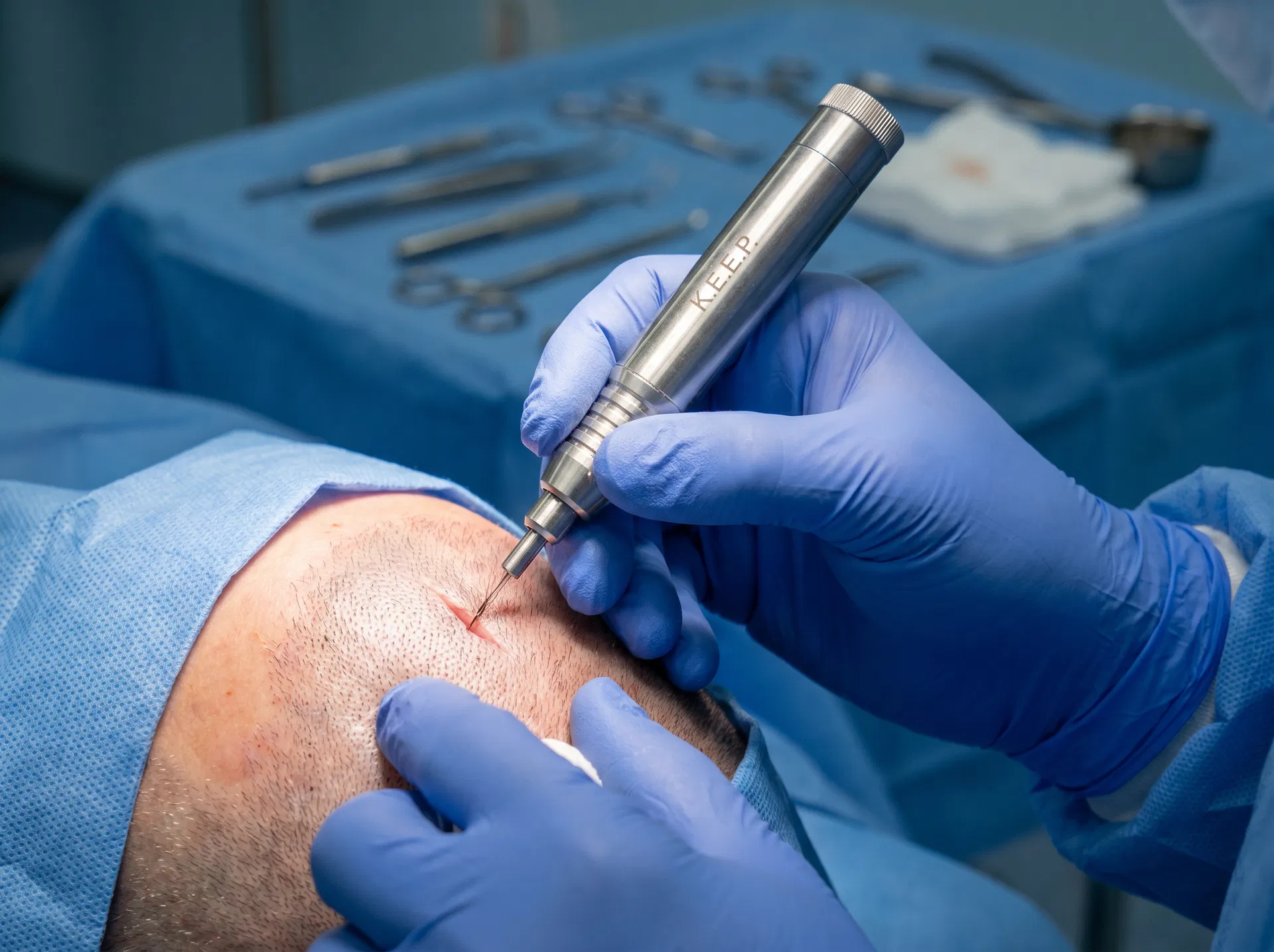 K.E.E.P. (Koray Erdogan Embedding Placer) hair transplant technique offered at ASMED Surgical Medical Center Turkey