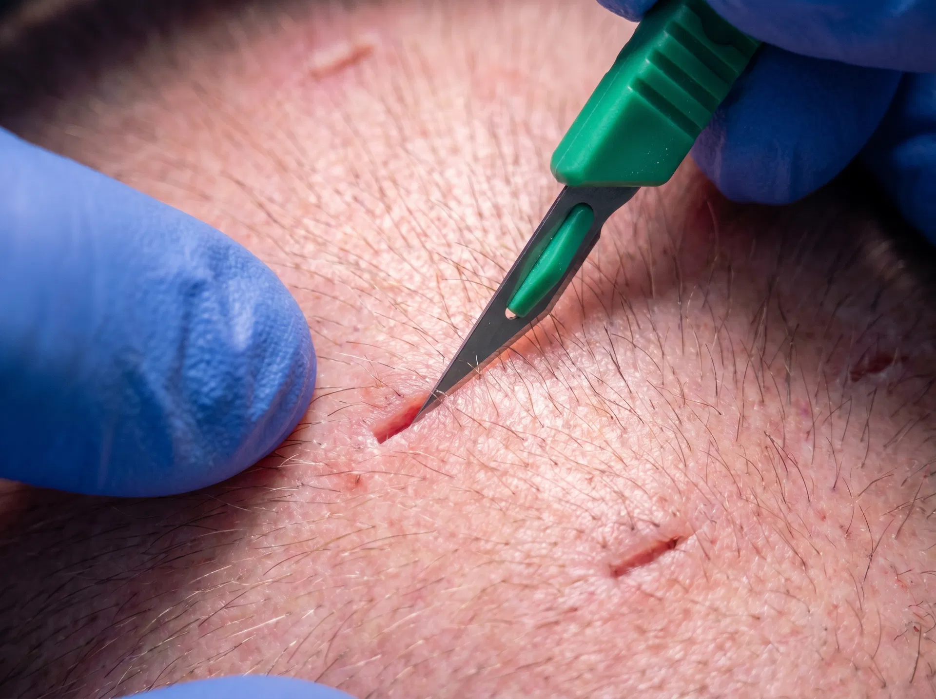 Lateral Slit Technique hair transplant technique offered at ASMED Surgical Medical Center Turkey