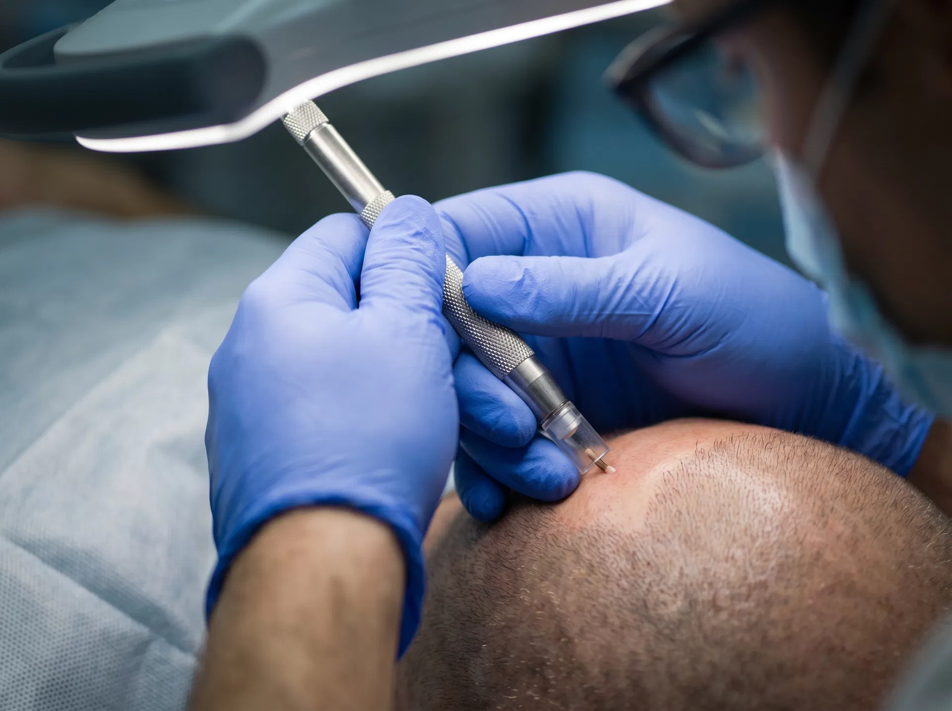 Manual FUE hair transplant technique offered at Dr. Cinik Hair Hospital Turkey